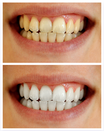 LED Teeth Whitening results
