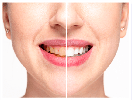 LED Teeth Whitening whiter results